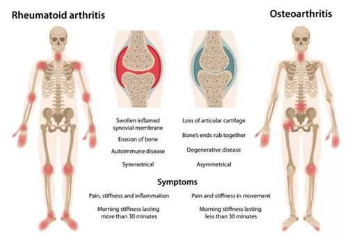 ARTHRITIS