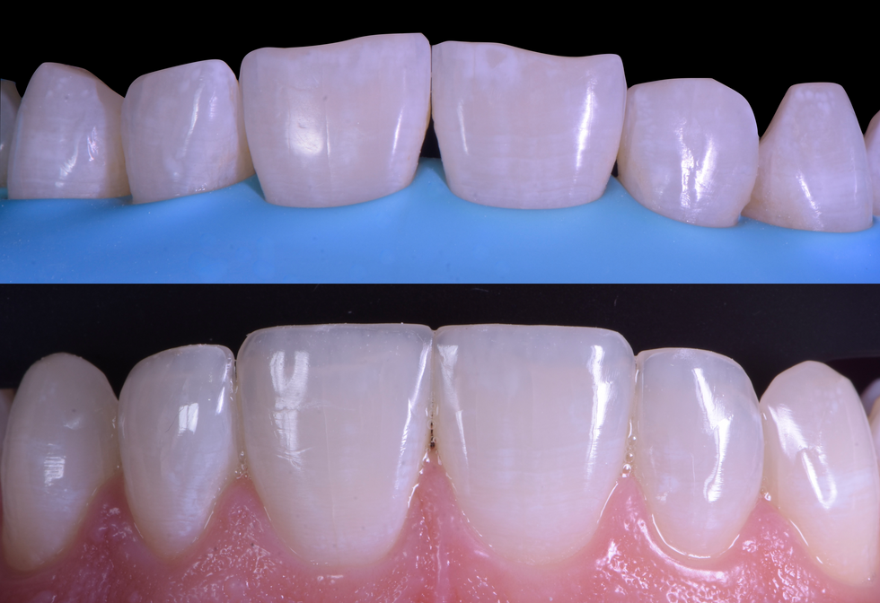 composite bonding.png