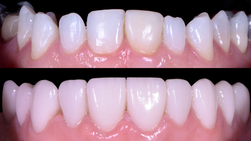 porcelain veneers.jpeg