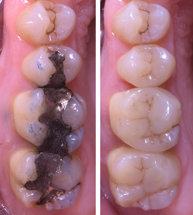 posterior composite bonding.png