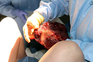Placenta examination