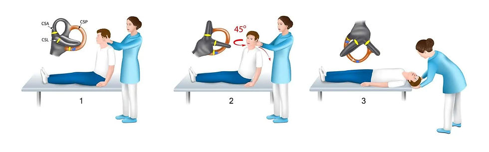 図1 引用:https://rasyaclinic.com/blog/vertigo/benign-paroxysmal-positional-vertigo-bppv-and-best-treatment-for-bppv/ より改変
