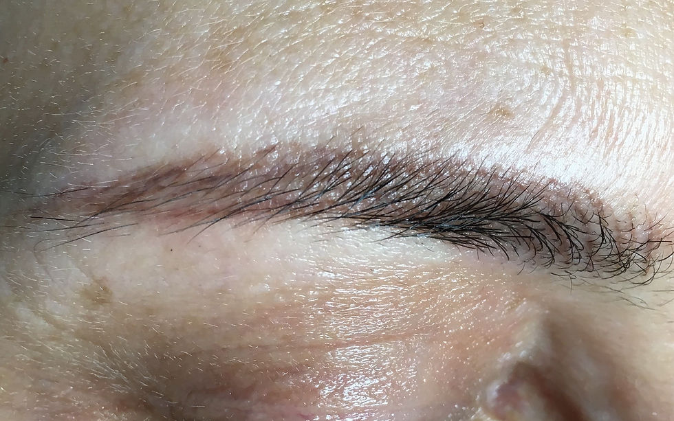 Beispiel 1: Augenbraue nach einer Microblading-Behandlung, schlecht abgeheilt
