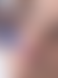 Microneedling Behandlung – natürliche Hautverjüngung mit feinen Nadeln für straffere Haut und Kollagenbildung