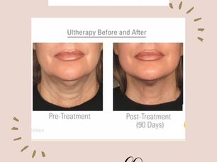 Ultherapy: Find out about this amazing Treatment: Gold Standard for Non Surgical Face Lift