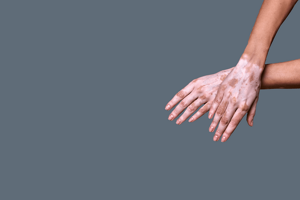 Vitiskin for vitiligo-2.png
