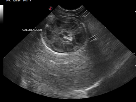 Gallbladder Mucocele