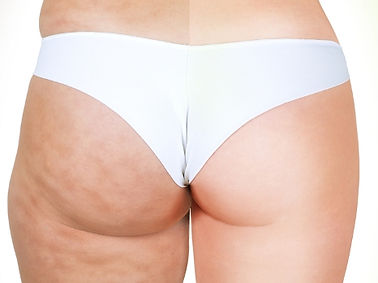 velashape-quali-i-costi.jpg