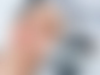 Laser Treatments for Acne, Scars, and Pigmentation