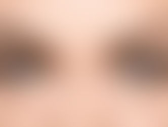 Brow Ptosis: 2 Ways to Fix Droopy Eyelids