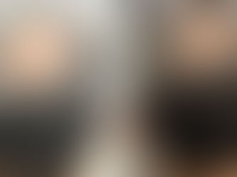 Alma TED Hair Restoration for Hair Loss