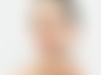 Bakersfield’s Secret to Flawless Skin: IPL Acne Treatment