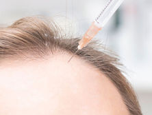 Exosomes vs PRP: Which Hair Loss Treatment is Better?