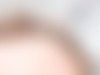 Exosomes vs PRP: Which Hair Loss Treatment is Better?