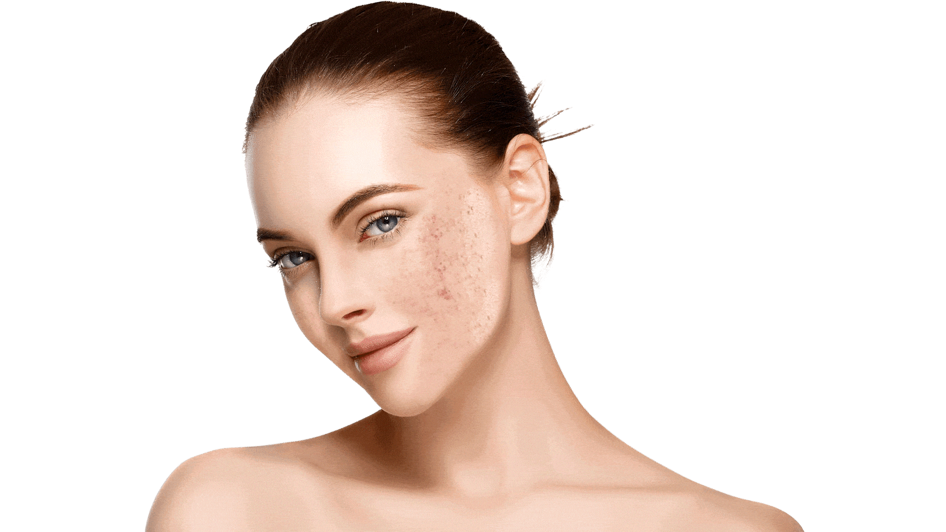 Acne treatment facial for clearer, blemish-free skin