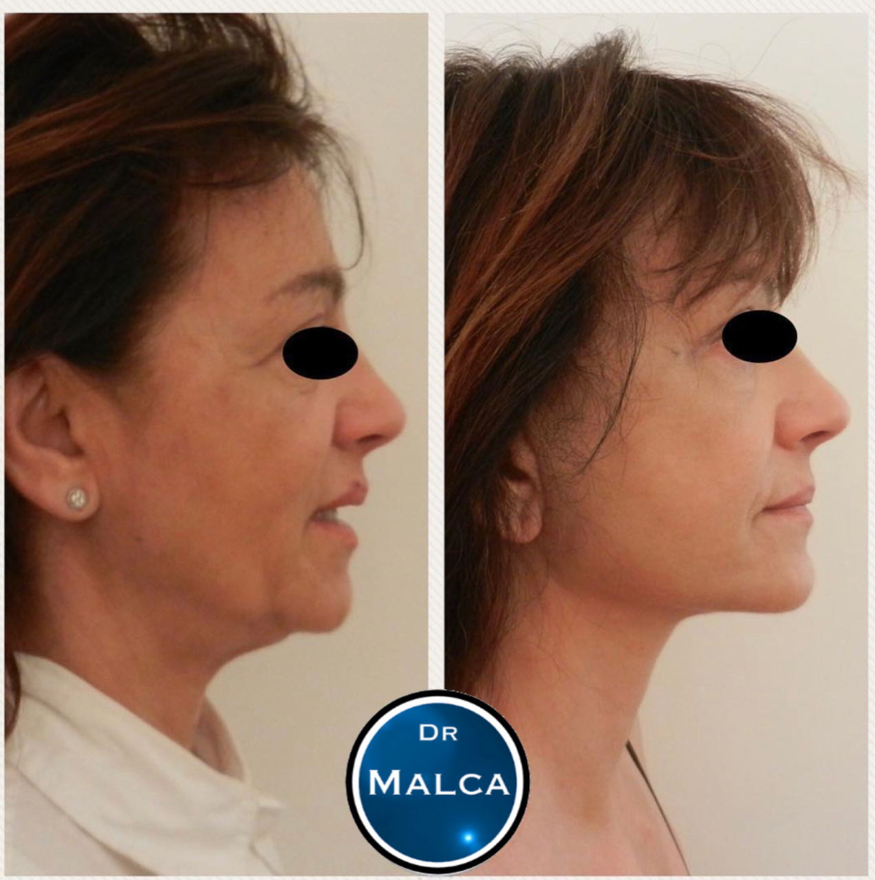Lifting facial exemple 1 réalisé par Docteur Malca