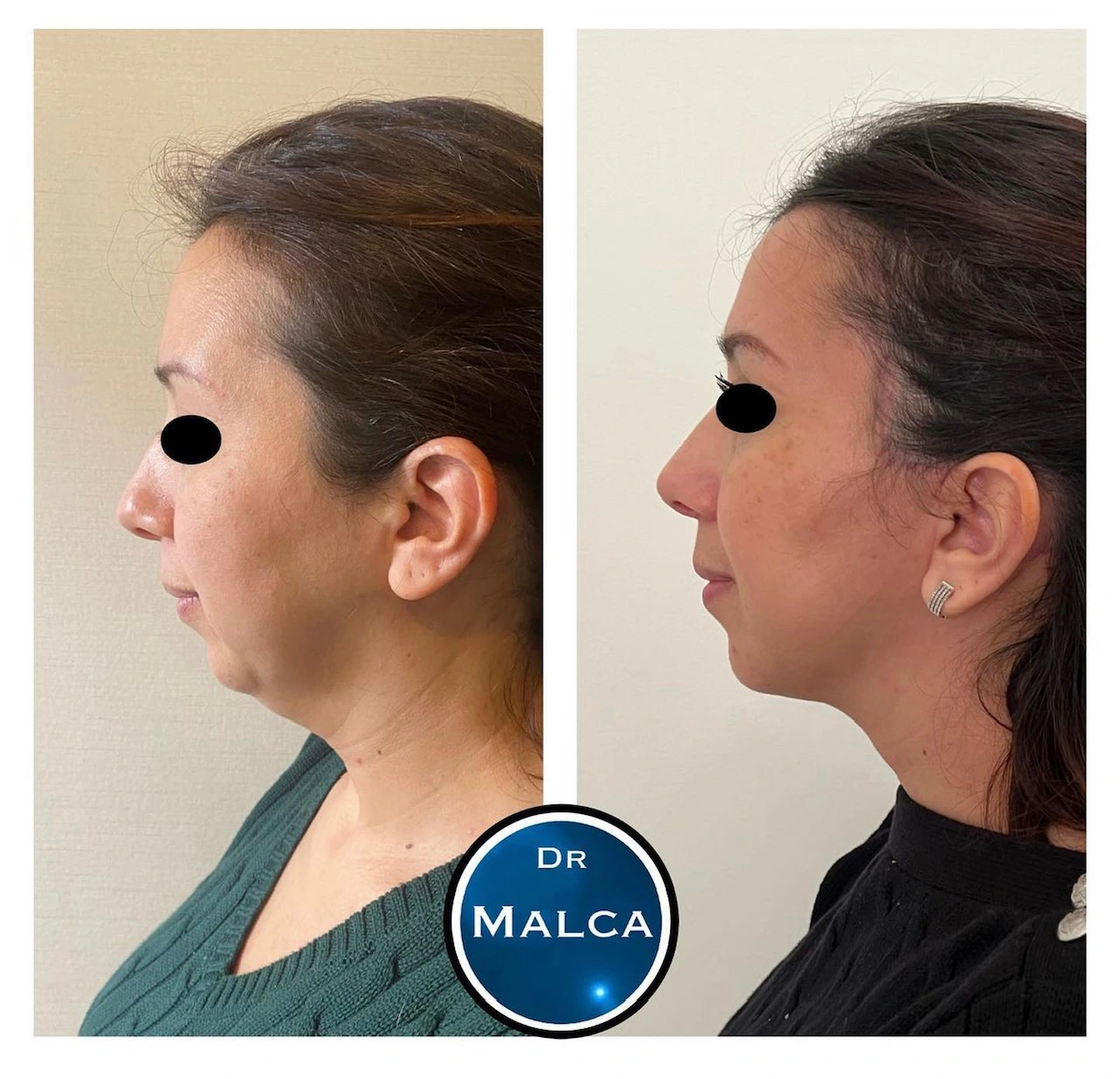 Lifting du visage exemple 3