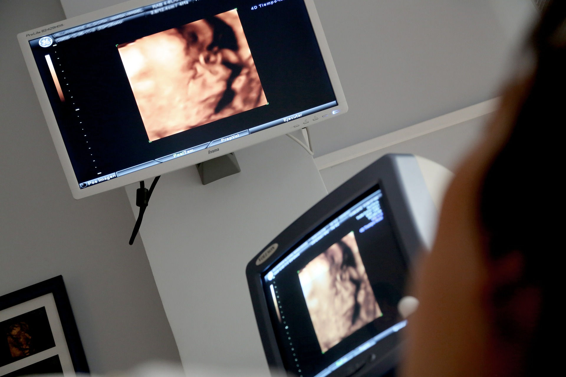 A computer screen showing a 3D image of a fetus