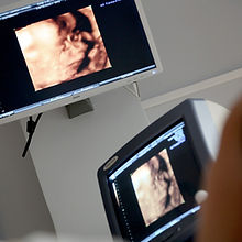3d Ultrasound