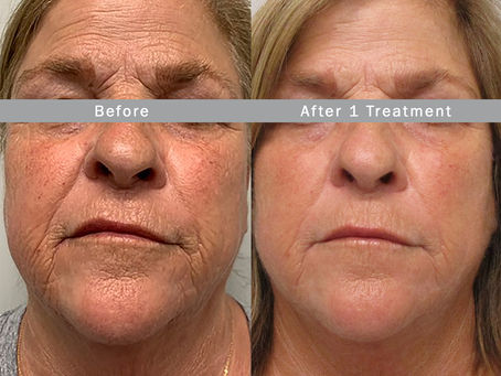 Morpheus8: The Latest Breakthrough in Customizable Skin Rejuvenation