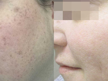 Revitalize Your Skin with Lumecca IPL: The Ultimate Skin Rejuvenation Solution