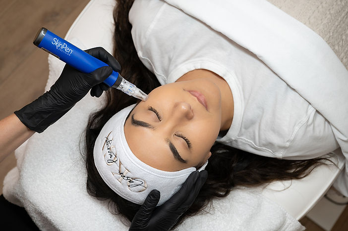 A woman receiving a SkinPen microneedling treatment in Oliver, BC at Okgn Laser Lounge, a medspa in the South Okanagan.
