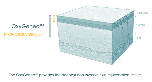 microderm-oxygeneo.gif