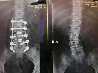 脊椎側彎診治--讓婆婆自己走路去買菜