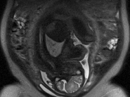 First successful mibirth scans!