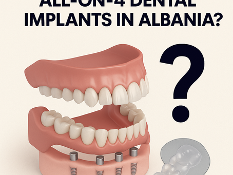 3D model showing All-on-4 dental implants representing Elonix Dental Clinic’s affordable and high-quality implant treatments in Albania.