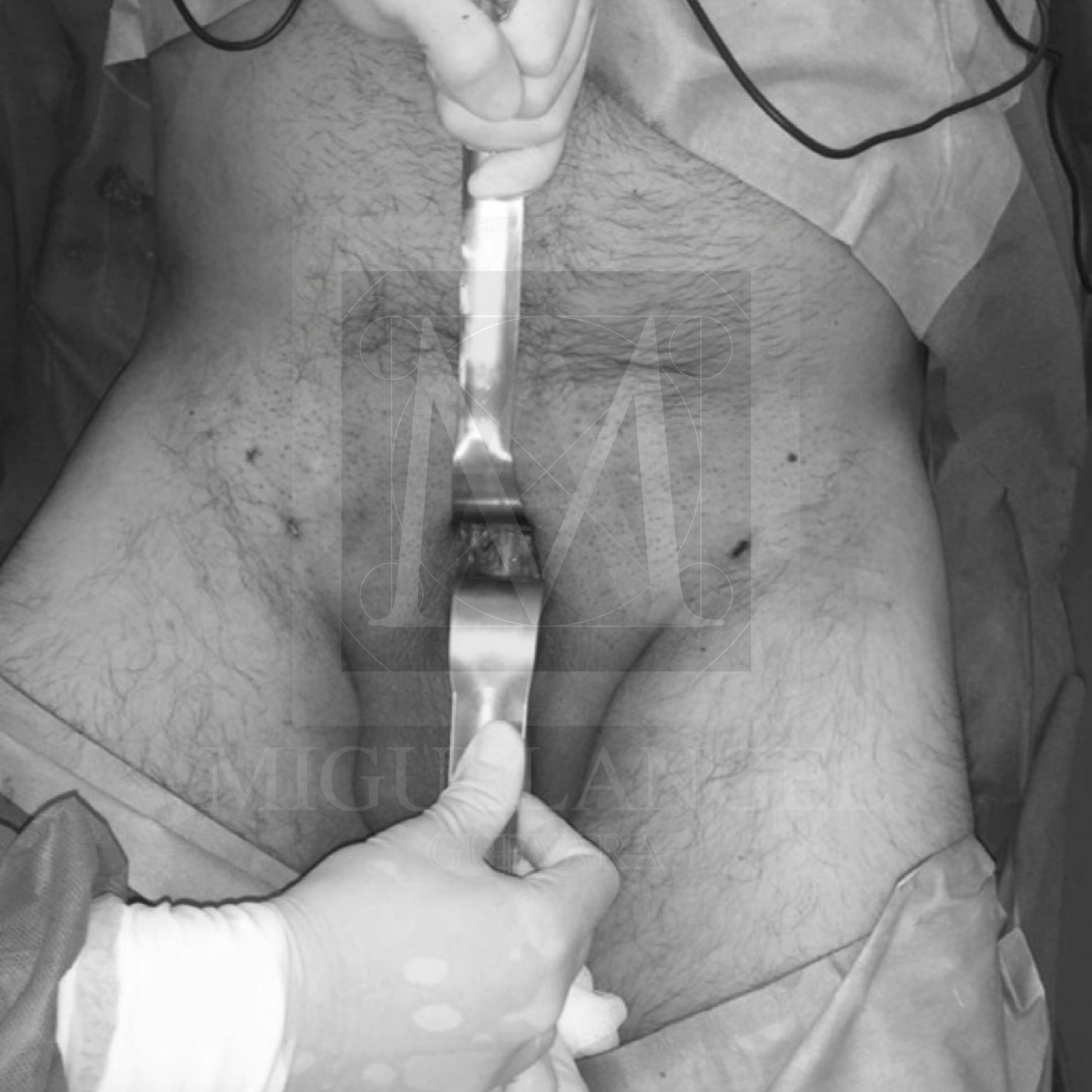 Cirugia de peneplastia precio
