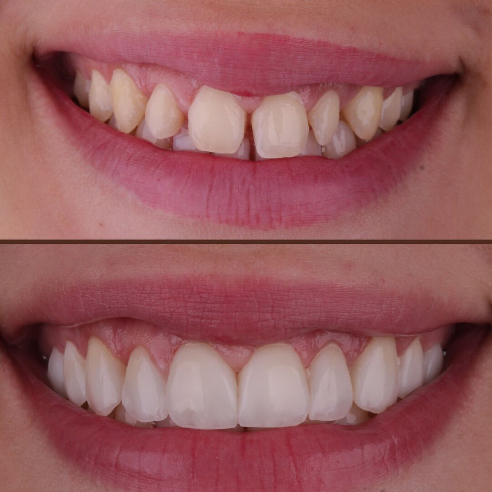 AntesDepois-Diastema (1).jpeg