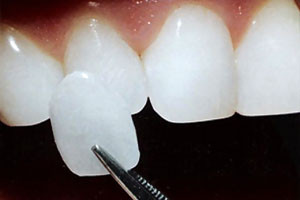 Porcelain and Glass Veneers for Esthetic Smiles