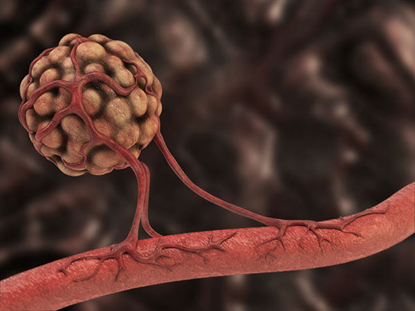 FDA Expands Use of Antiangiogenic to Kidney Cancer