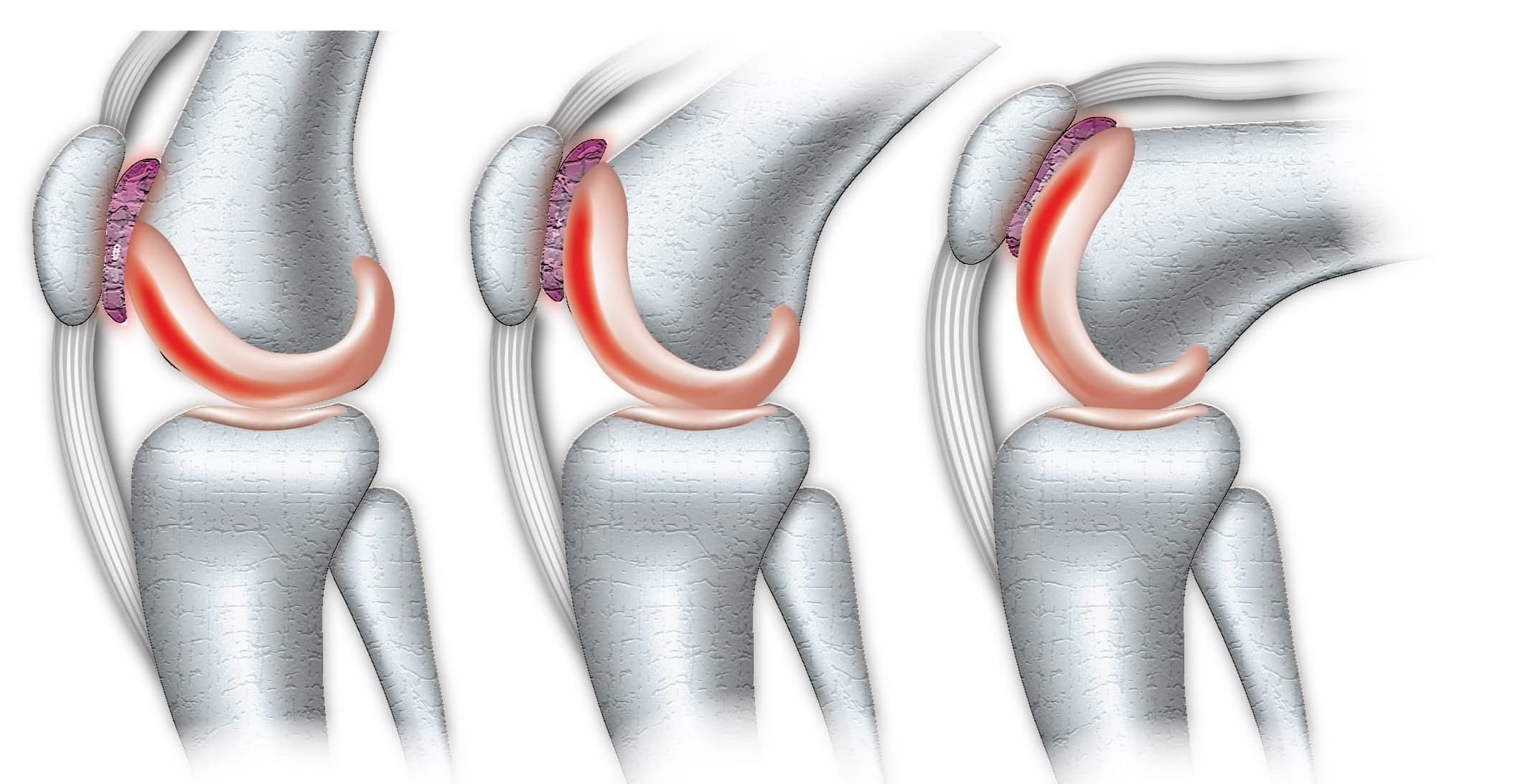 CHONDROMALACIA PATELLA