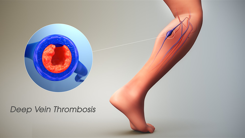 Deep Vein Thrombosis | Carolina Regional Orthopaedics