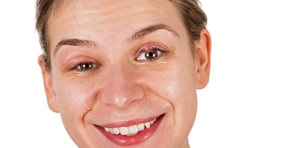 A Stye of the Upper Lid