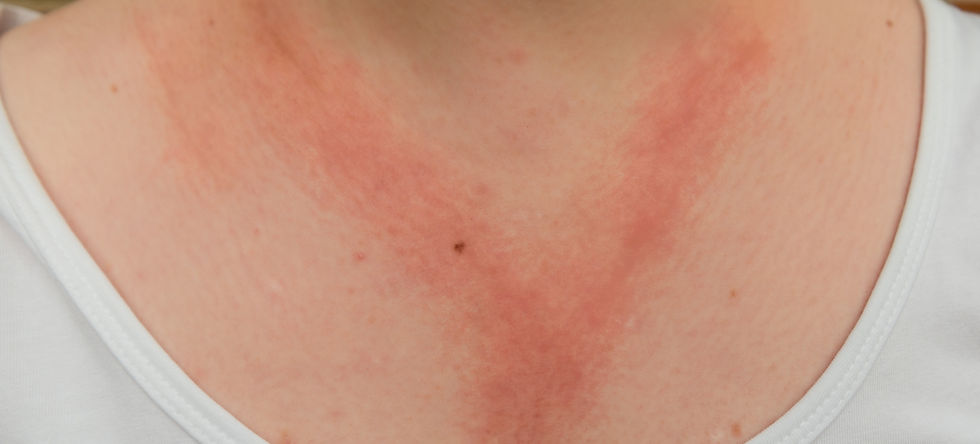 Allergy to a Metal Nacklace