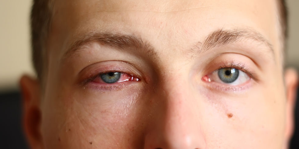 Irritated Eye: Viral Conjunctivitis