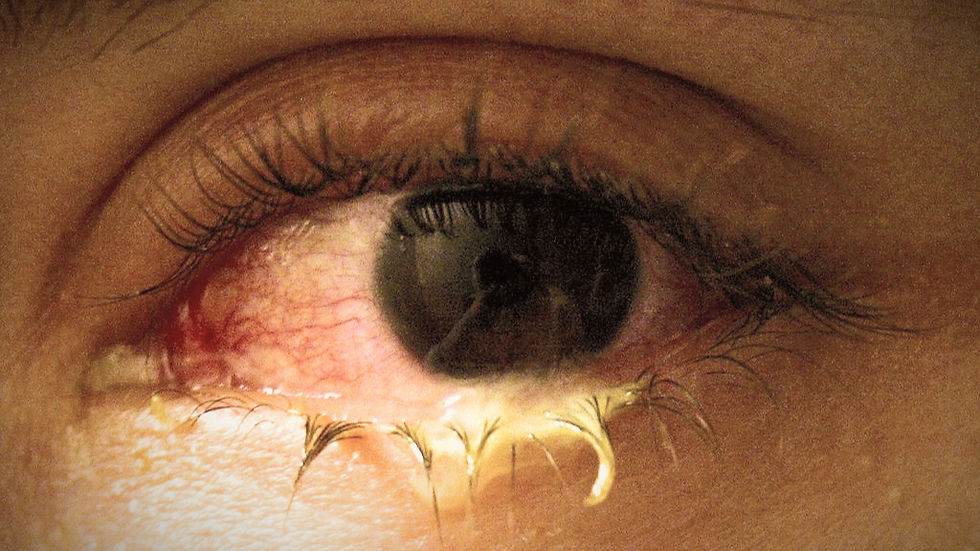 Bacterial Conjunctivitis - Excessive Purulent Drainage