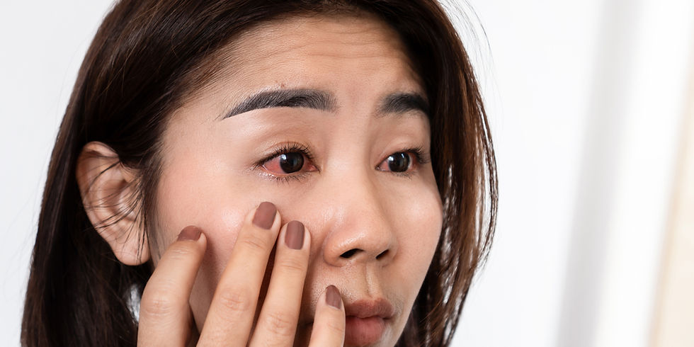 Pink Eye: Conjunctivitis