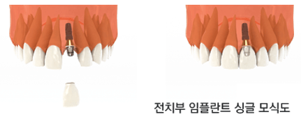 implant_method01.png