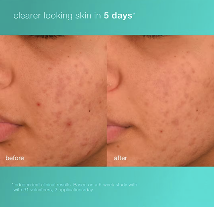 Thumbnail: Acne Biotic Moisturizer