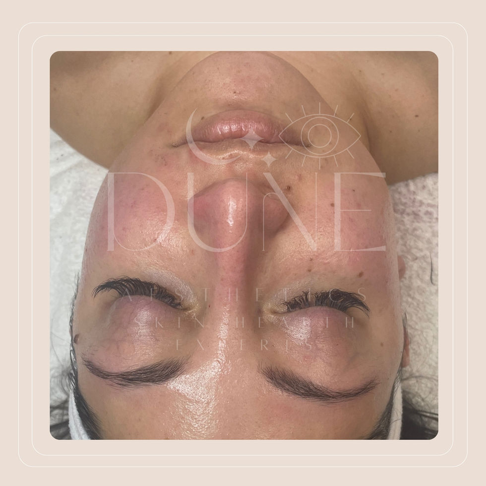 Dermaplaning Treatment