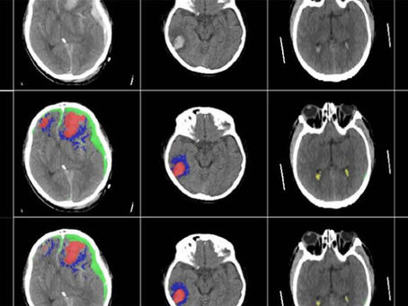 ¿Qué sabes de las lesiones cerebrales? 