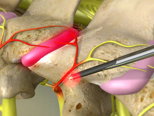 Endoscopic Medial Branch Nerve Rhizotomy vs. Traditional Percutaneous Radiofrequency Ablation: Advancing Pain Relief for Chronic Back Pain