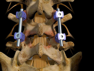 Understanding the Different Approaches to Lumbar Fusion: PLIF, TLIF, ALIF, and XLIF