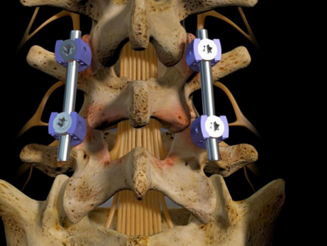 Understanding the Different Approaches to Lumbar Fusion: PLIF, TLIF, ALIF, and XLIF