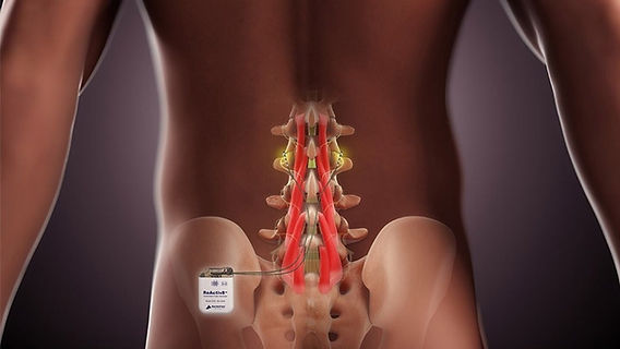 ReActiv8: A Breakthrough in Multifidus Neurorehabilitation for