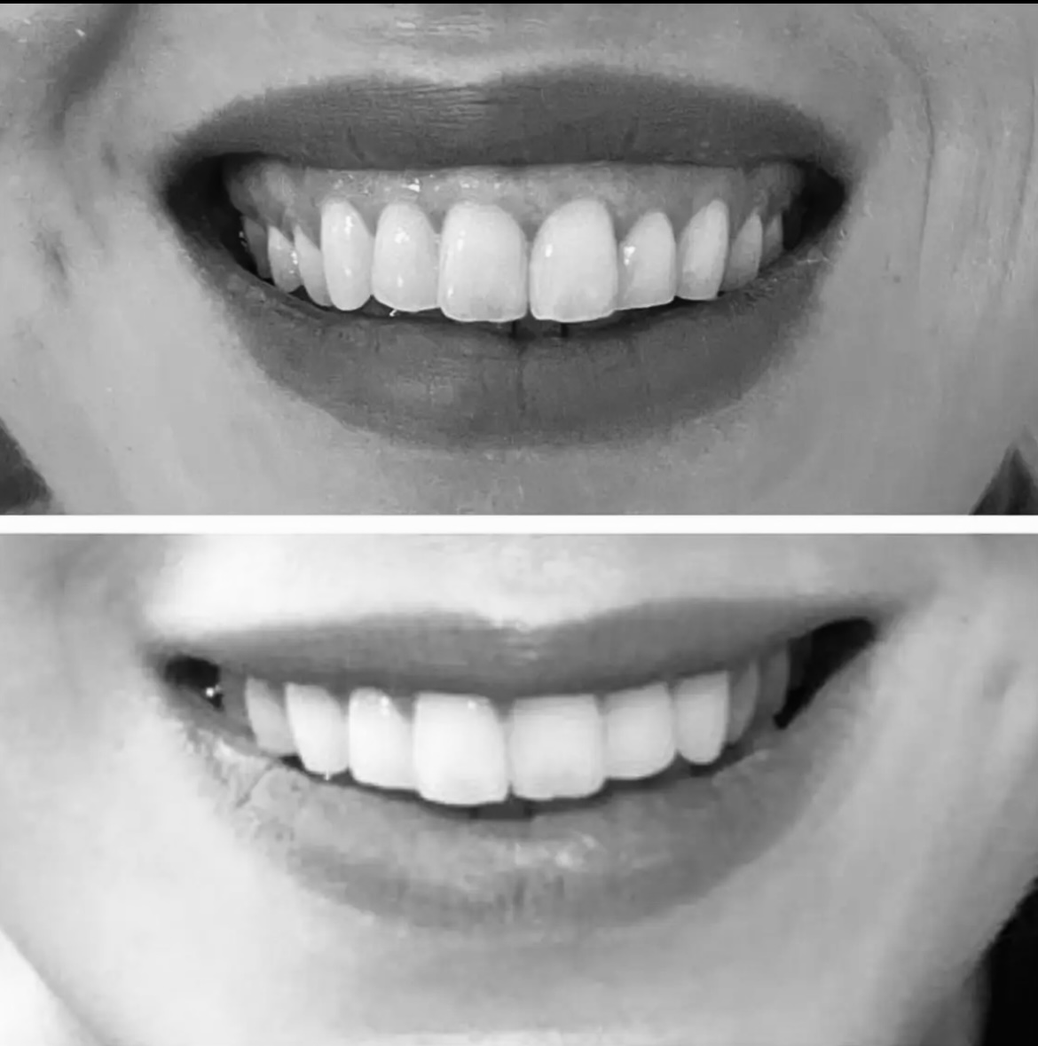 Anti-Wrinkle Treatments